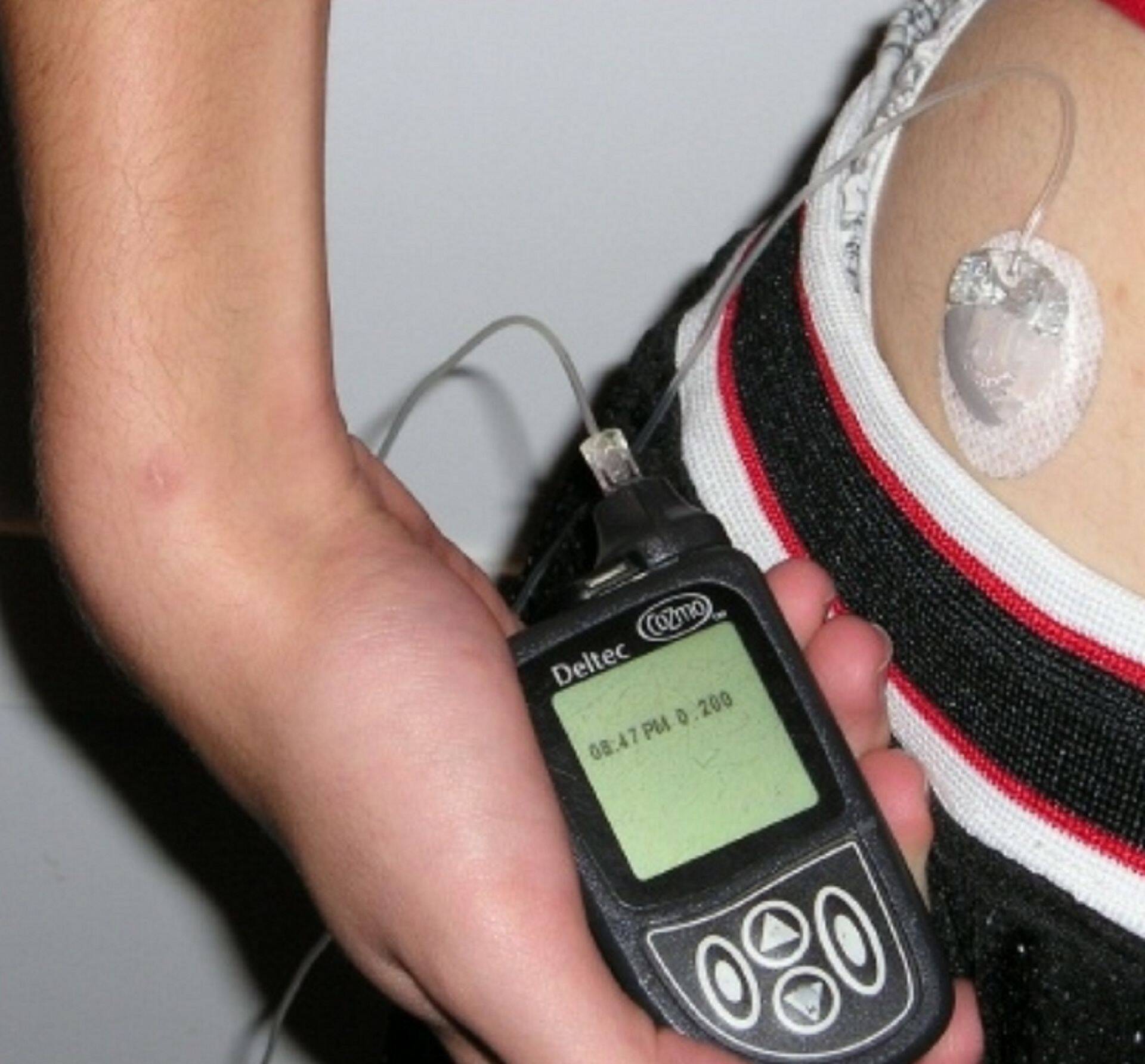 Kunstpankrease korral ei pea inimene insuliinipumba nupule vajutamisega vaeva nägema – nutitelefoniseade on ühenduses insuliinipumbaga ja süstimise süsteem toimib automaatselt.