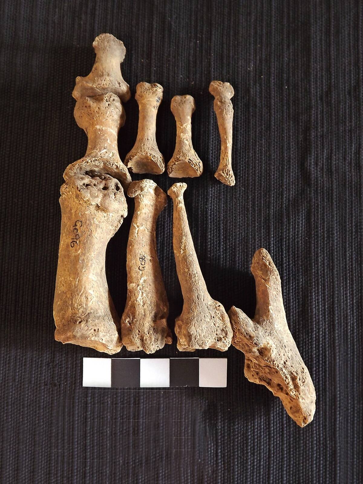 Luude analüüs (pildil jalalaba luud) tõi välja, et inimene kannatas oma eluajal pidalitõve käes.