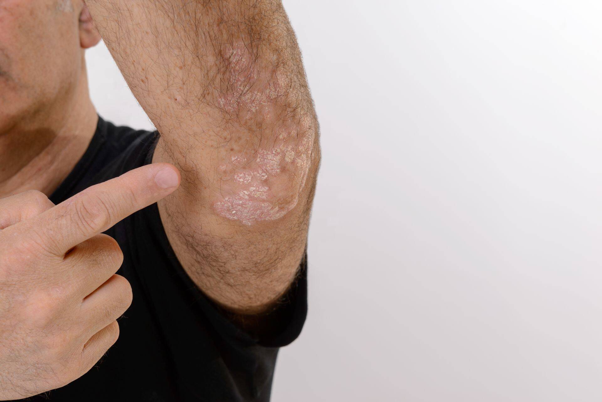Psoriaasi diagnoosimine ja ravi võib muutuda senisest täpsemaks ja odavamaks.