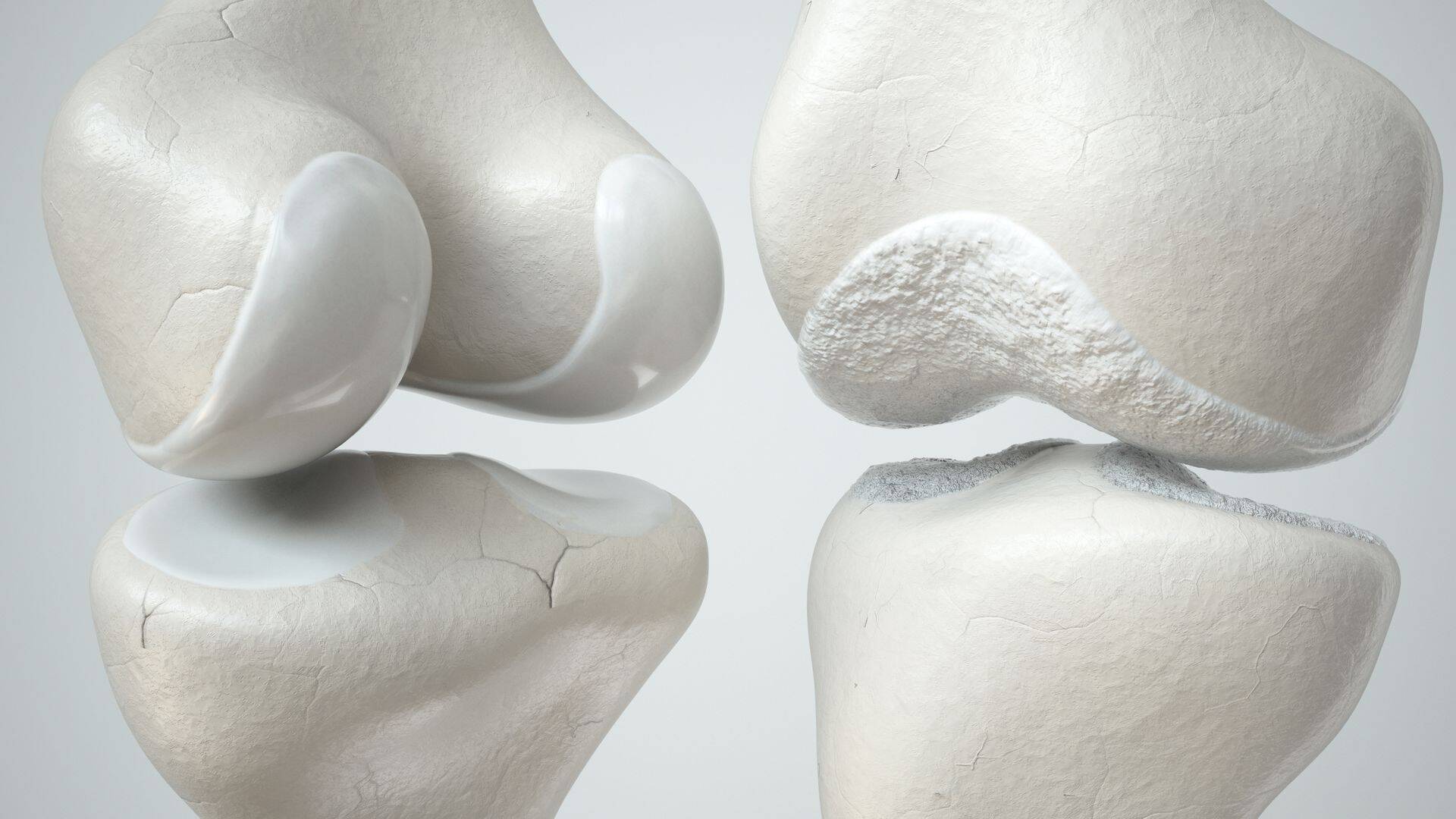 Terve liigese pind vs osteoartroosist tingitud kahjustusega.