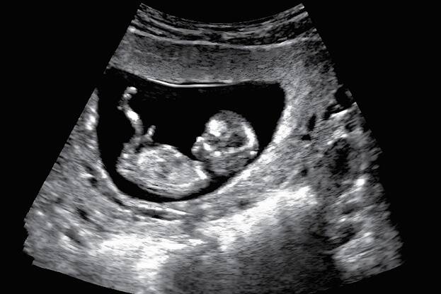12 nädala vanune embrüo ultrahelipildil. Foto on illustratiivne.