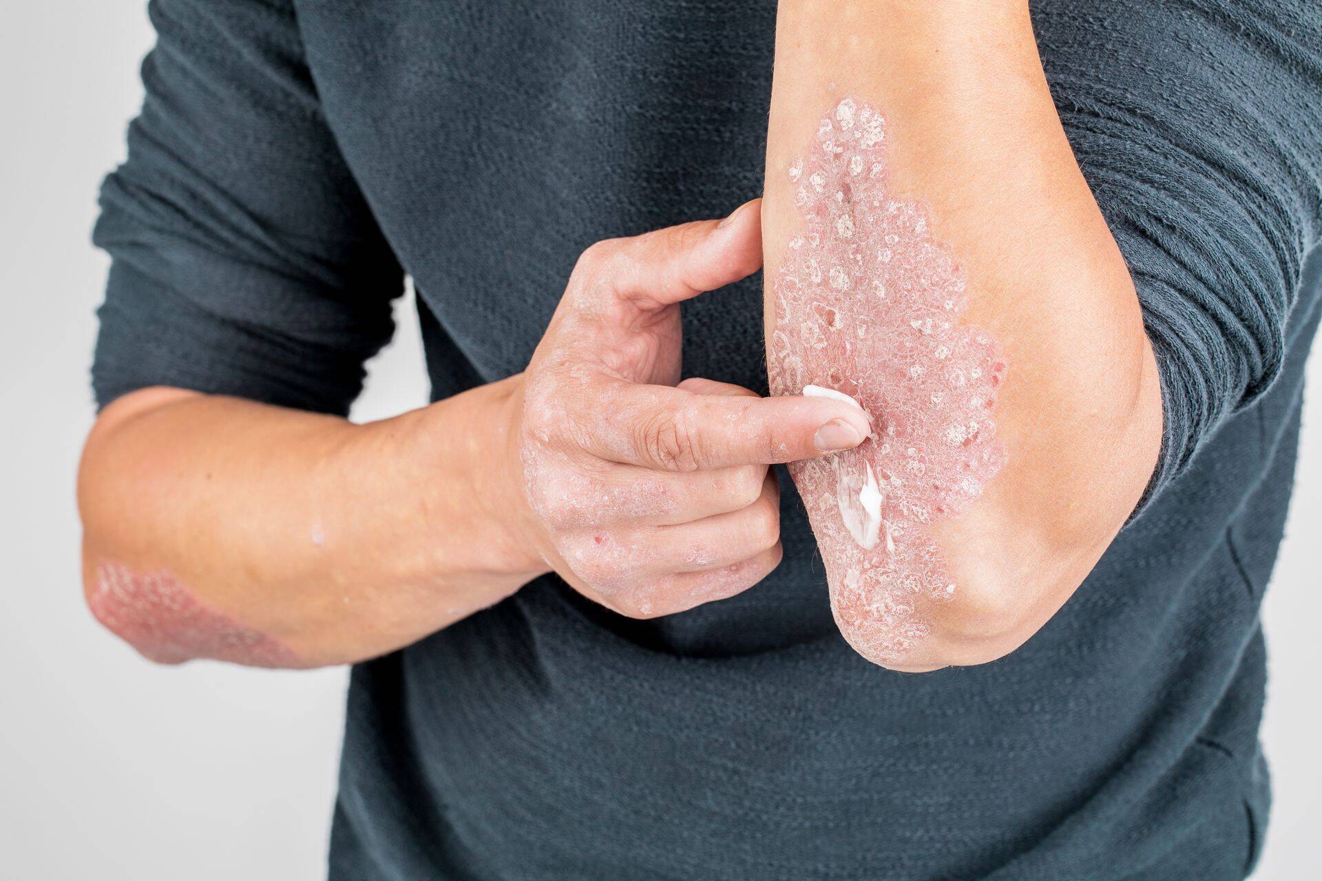 Psoriaasiravi ainult kreemidega paranemist ei too.