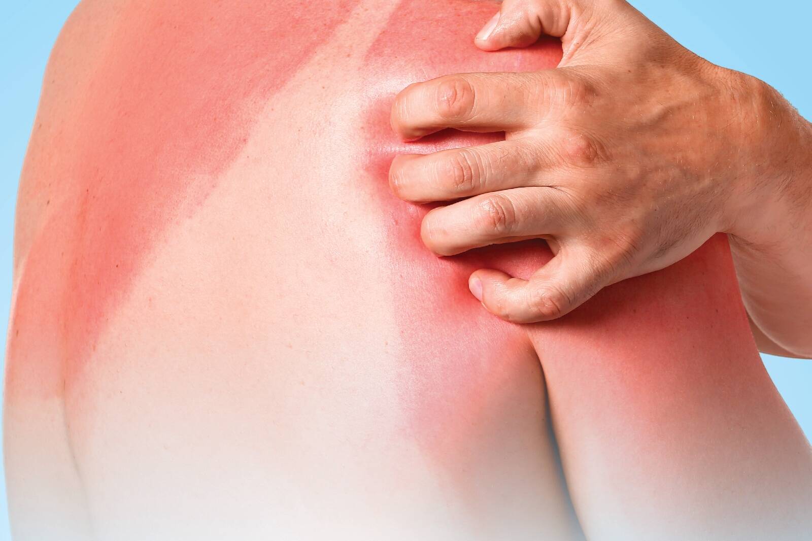 Miks päikesest põlenud nahk sügeleb?