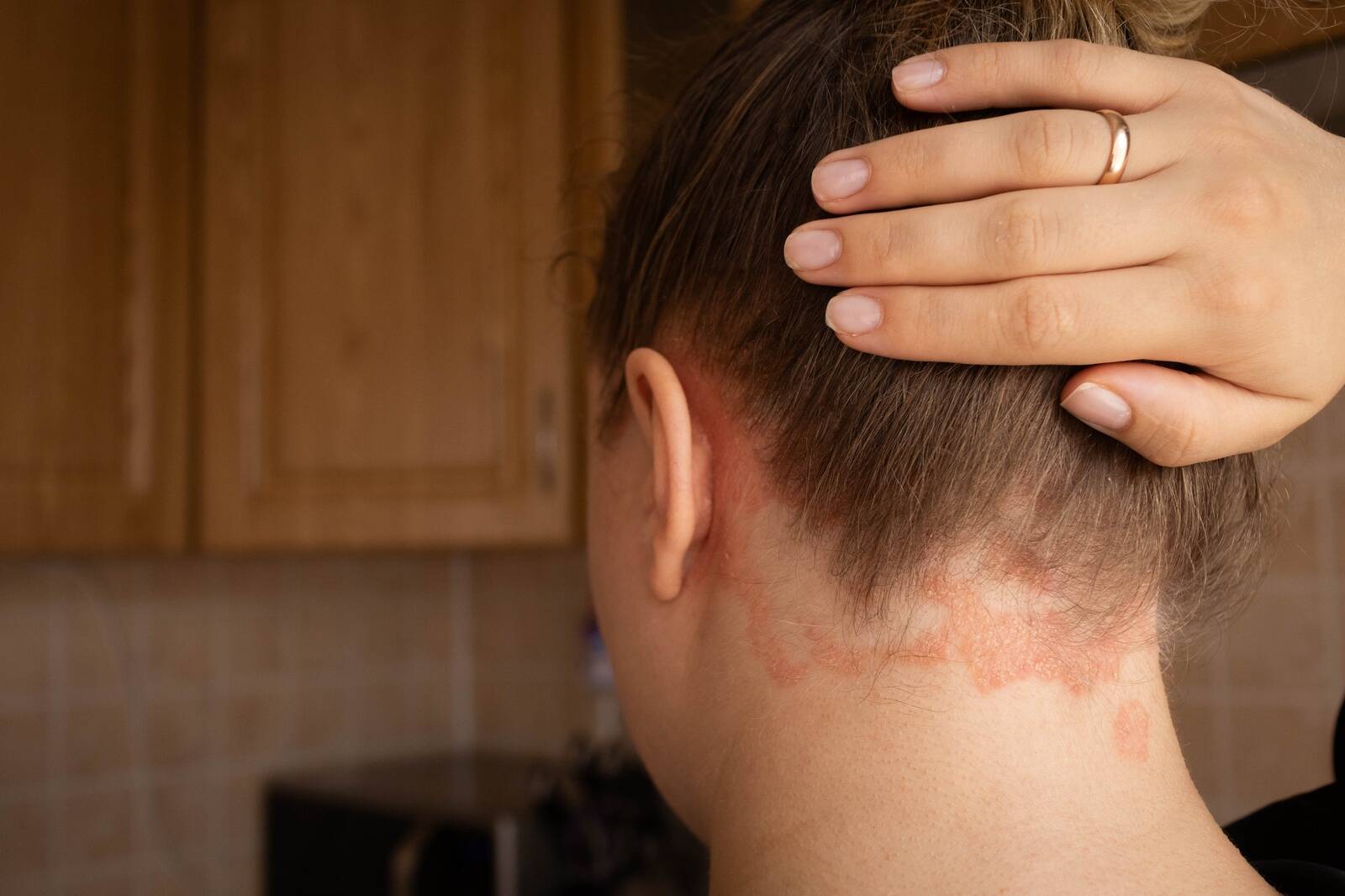 Psoriaas on pärilik haigus, mida esineb enim 16-22-aastastel ja uuesti 50-60-aastastel.